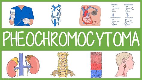 Pheochromocytoma In Minutes Youtube