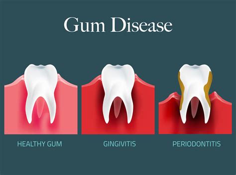 Can Gum Disease Kill You - emsekflol.com