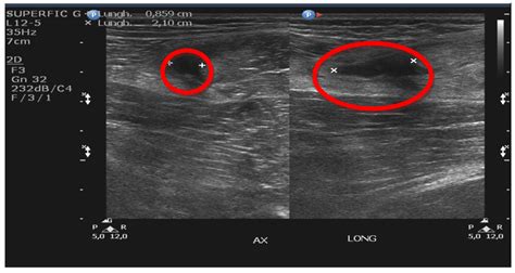 Diagnostic Imaging In Muscle Injury Intechopen