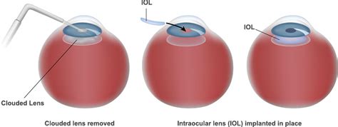 intraocular lens iols  redding red bluff chico ca