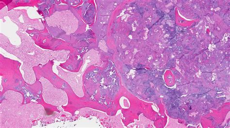 Chondrosarcoma Histology