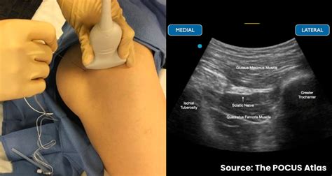 Transgluteal Sciatic Nerve Block