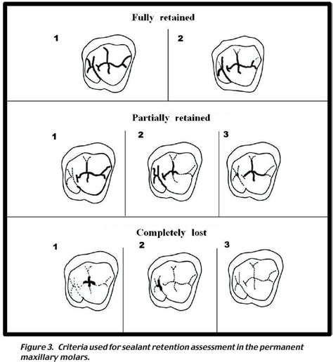 Pdf Effectiveness Of A Glass Ionomer Cement Used As A Pit And Fissure