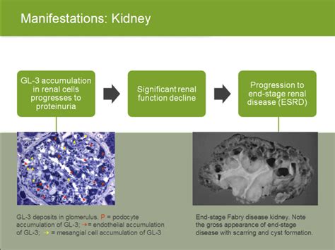 Fabry Disease The Nephrologist S Role Presentation By David G Warnock Md