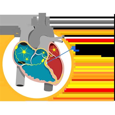 degupan jantung tidak sekata aritmia gleneagles hospital