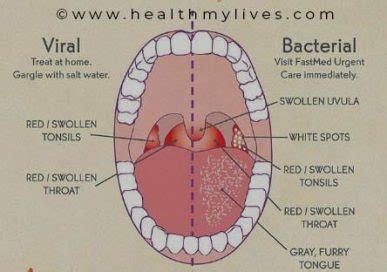 PHARYNGITIS-CAUSES, SYMPTOMS AND PREVENTION