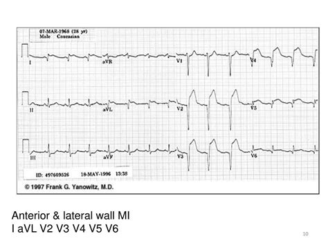 Ppt Electrocardiogram Ecg Iii Powerpoint Presentation Free Download