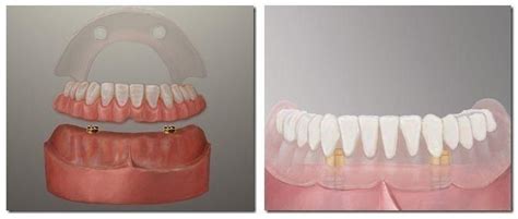 The Pros And Cons Of Implants Vs Dentures Arthur Street Dental