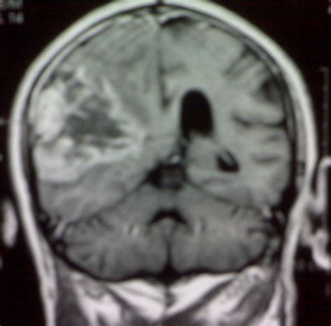 Gliosarcoma-MRI - Sumer's Radiology Blog