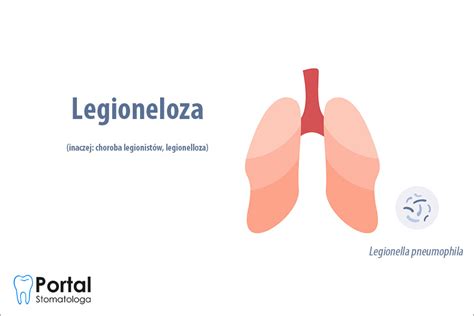 Legioneloza Portal Stomatologa