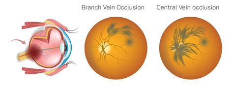 Navigating Retinal Vein Occlusion Prevention Diagnosis And Management