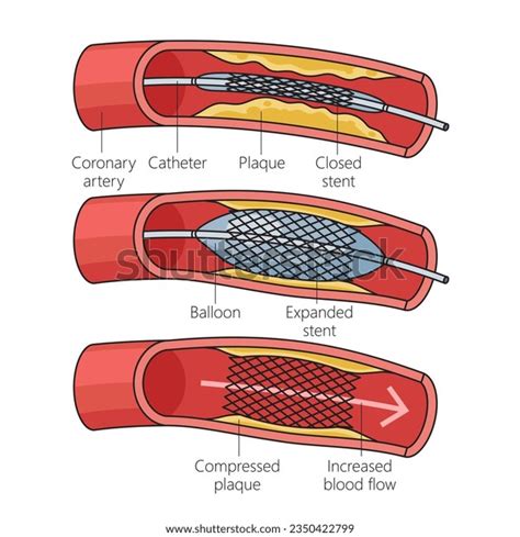 55 Coronary Stent Isolated Royalty-Free Images, Stock Photos & Pictures ...