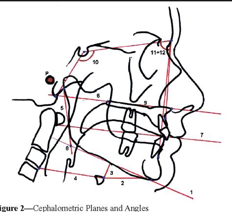 Figure From A Cephalometric Comparison Of Patients With The Sleep