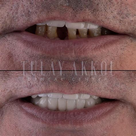 All On Six Dental Implants Restore Your Smile Today Akkoldental