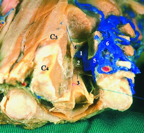 Epidural Vertebral Venous Plexus American Journal Of Neuroradiology