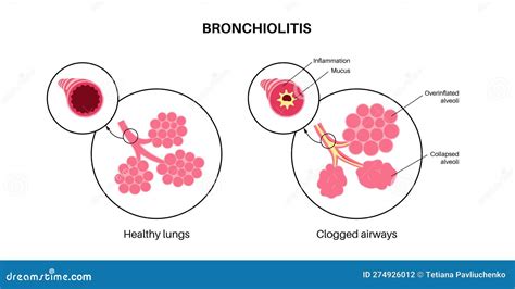 Bronchiolitis Lung Disease Stock Vector Illustration Of Pulmonary