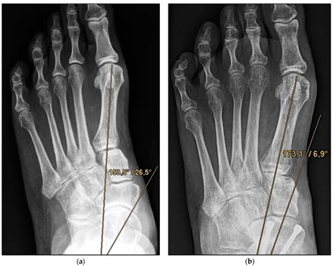 Pre And Post Operative Radiographic Findings Of Combined Talonavicular