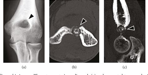 Figure 2 From Arthroscopic Excision Of Intra Articular Osteoid Osteoma