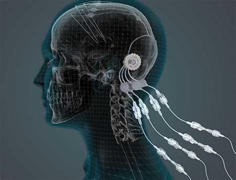 Brain implant delivers drugs directly through head | Engineering and ...