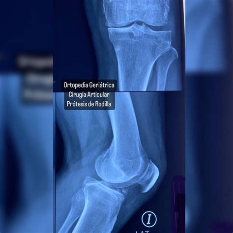 Ortopedia Geri Trica Cirug A Articular Pr Tesis De Rodilla Dr Jose