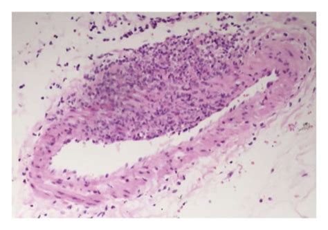 A H And E Stained Skin Punch Biopsy X20 Magnification Showing Loss