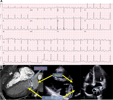 Atypical Flutter In A Patient With A Supra Annular Mitral Valve