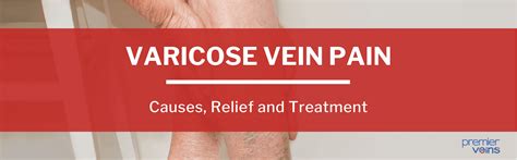 How To Manage Varicose Vein Pain