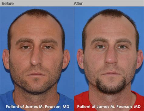 Septoplasty Deviated Nasal Septum Dr James Pearson Facial Plastic