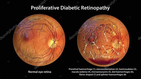 La Retinopat A Diab Tica Proliferativa Ilustraci N D Muestra