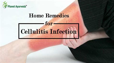 Cellulitis Infection According To Ayurveda Archives Planet Ayurveda