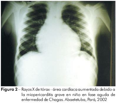 Alteraciones electrocardiográficas durante y después de tratamiento con