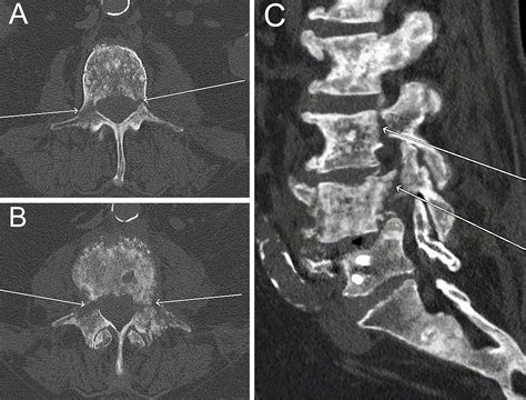 Vertebral pedicle fracture – NSPDD