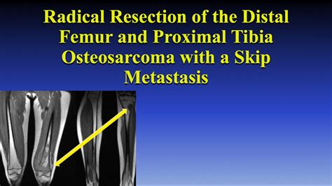 Radical Resection Of The Distal Femur And Proximal Tibia For An