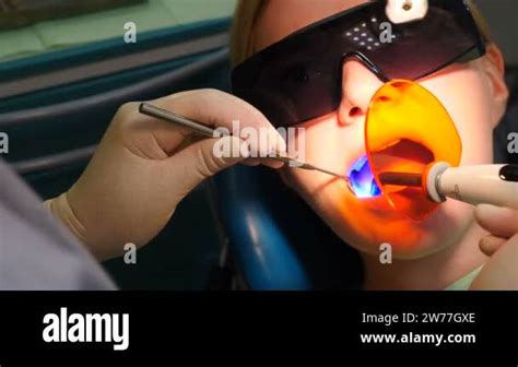 Dentist Fixing Light Filling Using Photopolymer Dental Cordless Lamp