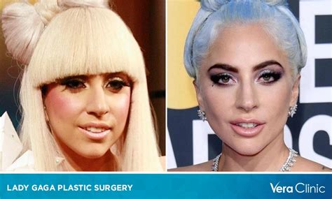 Lady Gaga Plastic Surgery Unveiling The Transformation