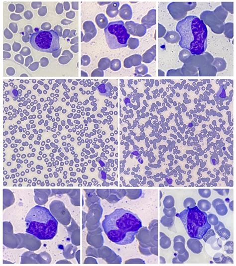 Atypical Lymphocytes in infectious mononucleosis