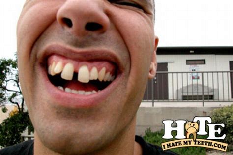 The Worst Teeth Ever 31 Pics