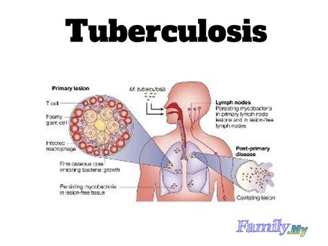 tuberculosis malaysia health family medicine  healthcare