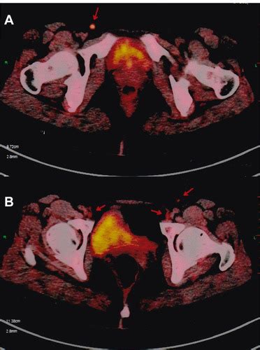 Full Article Primary Diffuse Large B Cell Lymphoma Of The Female