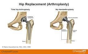 Total hip arthroplasty. - Expert Writers