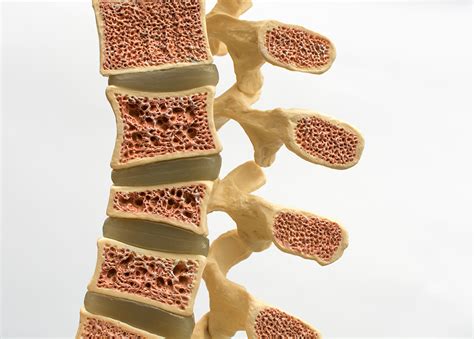 Osteoporosis Qu Es S Ntomas Y Tratamientos Cl Nica Dkf