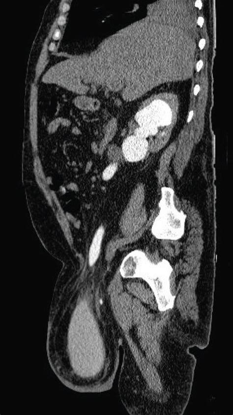 Abdominal Pelvic Ct Scan With Endovenous Contrast Right Inguinal