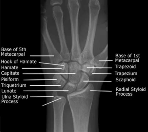 MSK Disorders Of Hand And Wrist Flashcards Quizlet