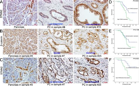 The Expression Of Stmn2 And β Catenin In Human Pc And Adjacent Pancreas Download Scientific