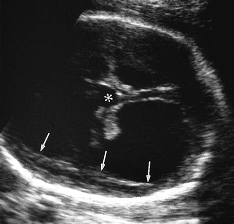 Hydranencephaly Ultrasound