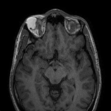 Dermolipoma Of The Orbit Image