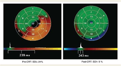 Figure 1 From Comparison Of Quick Optimization Of Interventricular