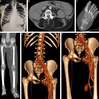 X Ray And Contrast Enhanced Computed Tomography Findings A