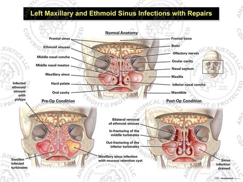 Maxillary And Ethmoid Sinus Disease