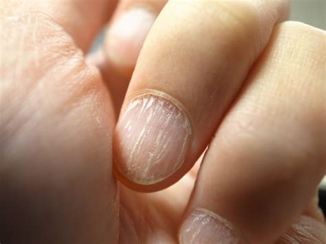 Split Nails What Causes Split Nails And How To Repair Them Nail